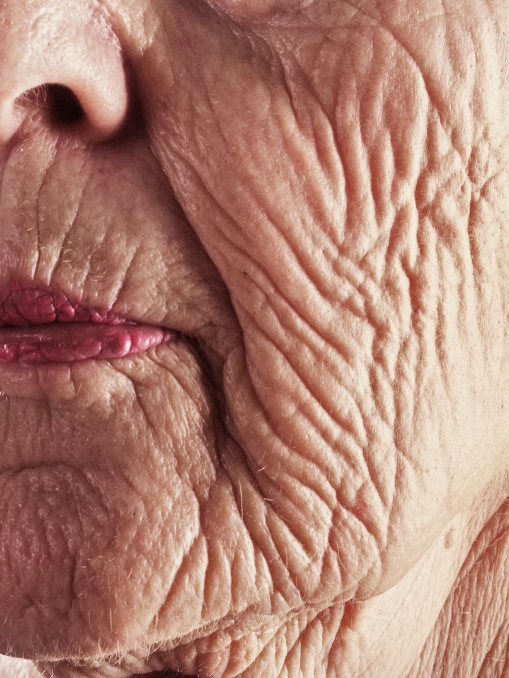 Premature skin ageing is caused by prolonged sun exposure